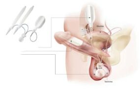 Chirurgia męskich narządów płciowych