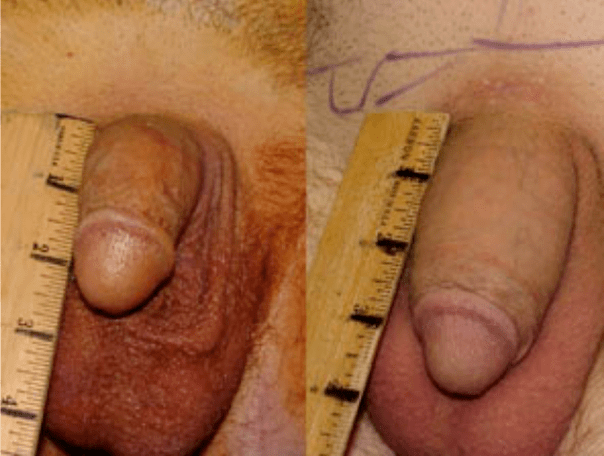 Przed i po lipofillingu i implantacji żelu